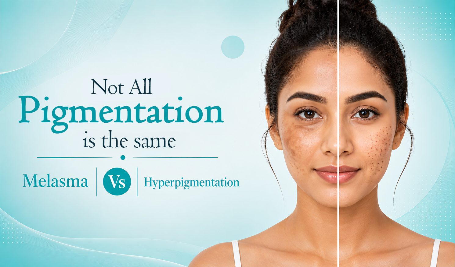 Not All Pigmentation Is the Same: Melasma vs Hyperpigmentation