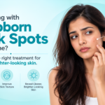 Woman highlighting dark spots on her cheek after acne, illustrating post-acne pigmentation treatment.